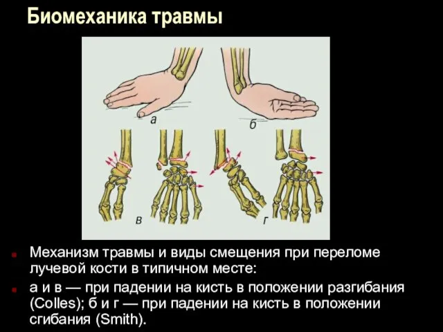 Биомеханика травмы Механизм травмы и виды смещения при переломе лучевой