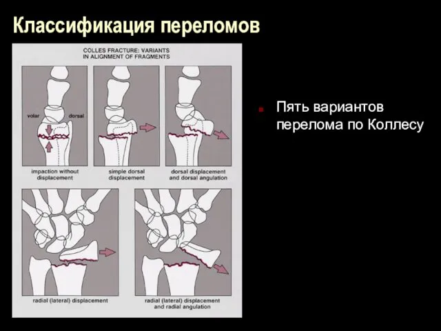 Классификация переломов Пять вариантов перелома по Коллесу