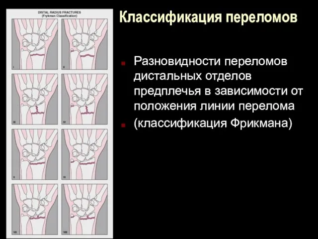 Классификация переломов Разновидности переломов дистальных отделов предплечья в зависимости от положения линии перелома (классификация Фрикмана)