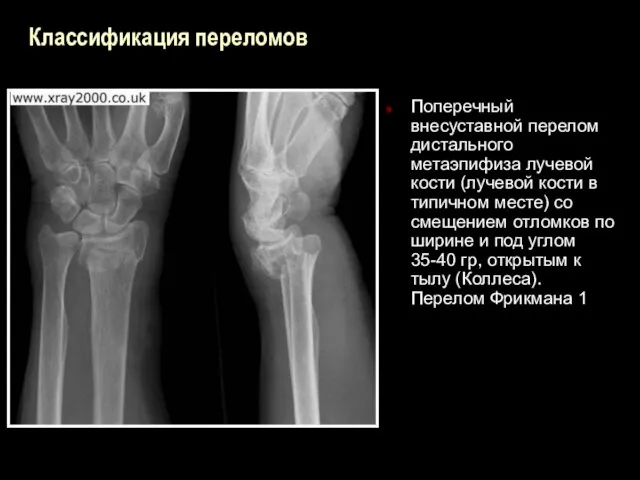 Классификация переломов Поперечный внесуставной перелом дистального метаэпифиза лучевой кости (лучевой