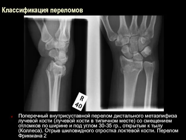 Классификация переломов Поперечный внутрисуставной перелом дистального метаэпифиза лучевой кости (лучевой