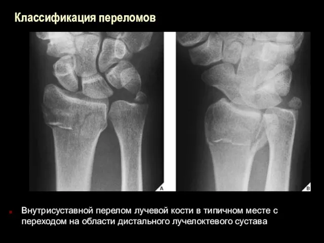 Классификация переломов Внутрисуставной перелом лучевой кости в типичном месте с переходом на области дистального лучелоктевого сустава