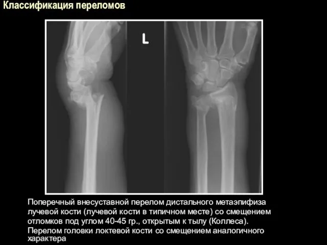 Классификация переломов Поперечный внесуставной перелом дистального метаэпифиза лучевой кости (лучевой