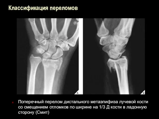 Классификация переломов Поперечный перелом дистального метаэпифиза лучевой кости со смещением