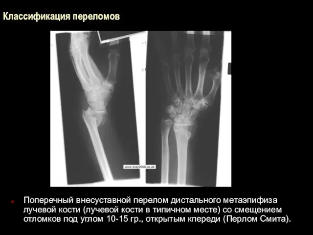 Классификация переломов Поперечный внесуставной перелом дистального метаэпифиза лучевой кости (лучевой