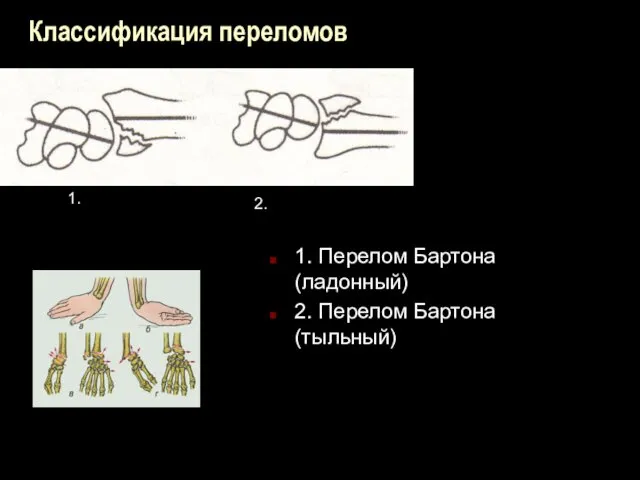 Классификация переломов 1. Перелом Бартона (ладонный) 2. Перелом Бартона (тыльный) 1. 2.