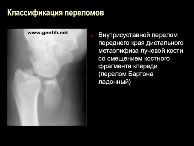 Классификация переломов Внутрисуставной перелом переднего края дистального метаэпифиза лучевой кости