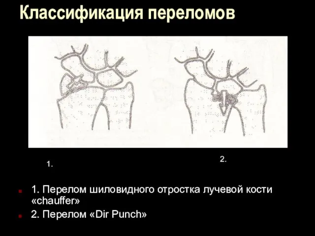 Классификация переломов 1. Перелом шиловидного отростка лучевой кости «chauffer» 2. Перелом «Dir Punch» 1. 2.