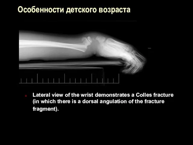 Особенности детского возраста Lateral view of the wrist demonstrates a