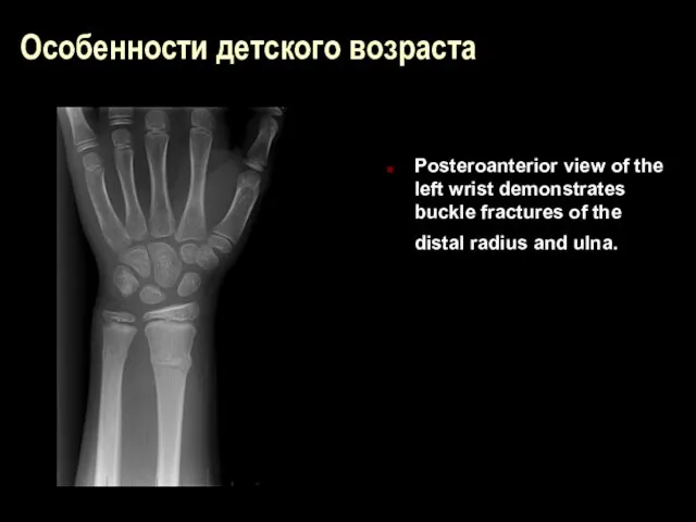 Особенности детского возраста Posteroanterior view of the left wrist demonstrates