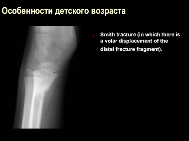 Особенности детского возраста Smith fracture (in which there is a