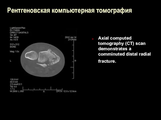 Рентгеновская компьютерная томография Axial computed tomography (CT) scan demonstrates a comminuted distal radial fracture.