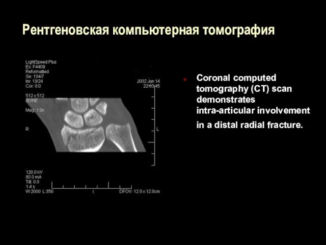 Рентгеновская компьютерная томография Coronal computed tomography (CT) scan demonstrates intra-articular involvement in a distal radial fracture.