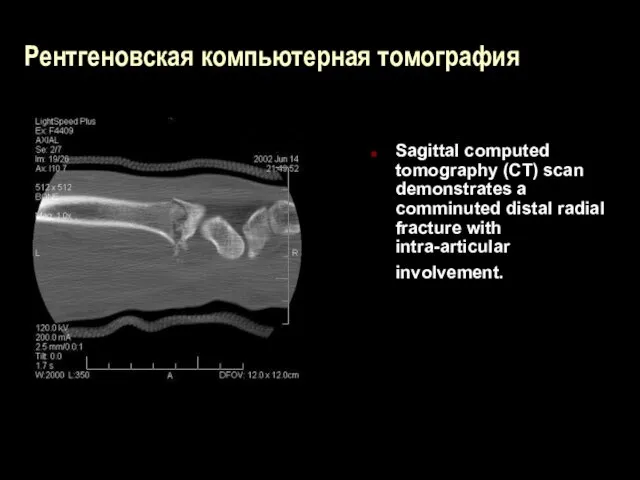 Рентгеновская компьютерная томография Sagittal computed tomography (CT) scan demonstrates a