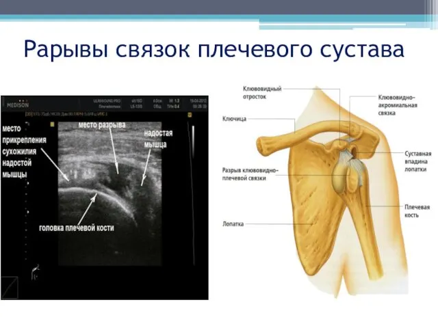 Рарывы связок плечевого сустава