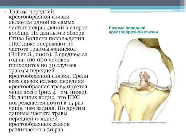 Травма передней крестообразной связки является одной из самых частых повреждений