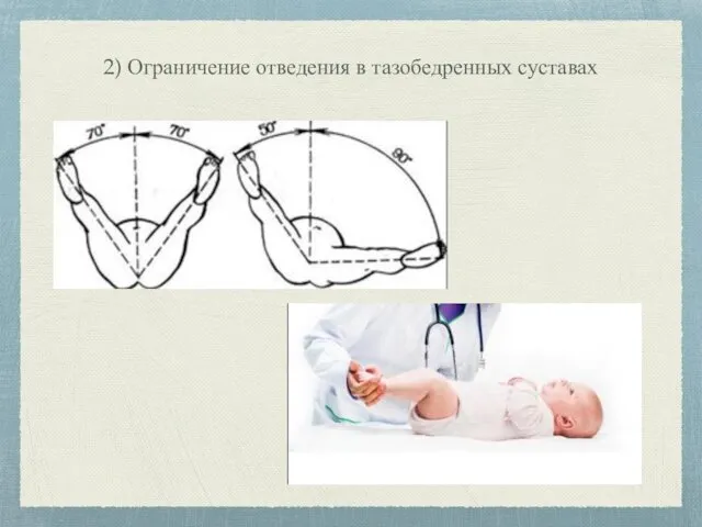 2) Ограничение отведения в тазобедренных суставах