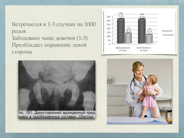 Встречается в 1-3 случаях на 1000 родов Заболевают чаще девочки (1:3) Преобладает поражение левой стороны