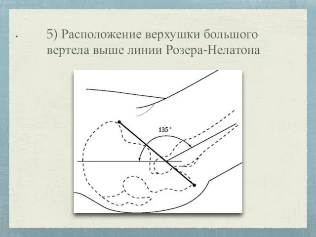 5) Расположение верхушки большого вертела выше линии Розера-Нелатона