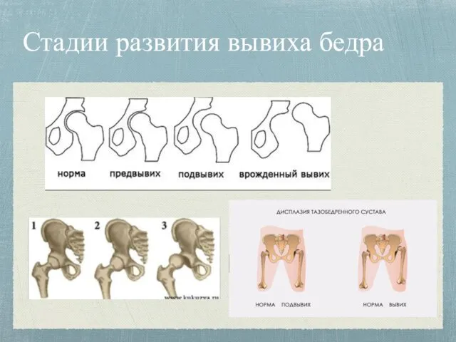 Стадии развития вывиха бедра