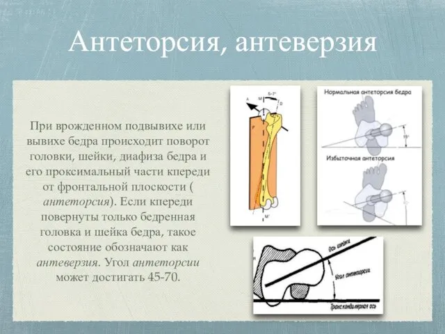 Антеторсия, антеверзия При врожденном подвывихе или вывихе бедра происходит поворот