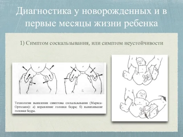 Диагностика у новорожденных и в первые месяцы жизни ребенка 1) Симптом соскальзывания, или симптом неустойчивости