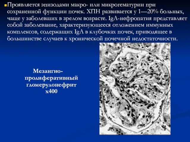 Мезангио-пролиферативный гломерулонефрит х400 Проявляется эпизодами макро- или микрогематурии при сохраненной