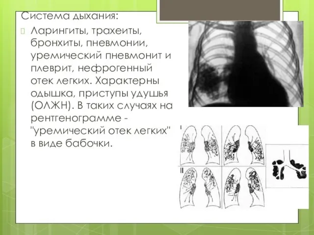 Система дыхания: Ларингиты, трахеиты, бронхиты, пневмонии, уремический пневмонит и плеврит,