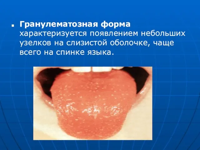 Гранулематозная форма характеризуется появлением небольших узелков на слизистой оболочке, чаще всего на спинке языка.