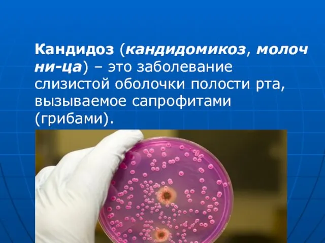 Кандидоз (кандидомикоз, молочни-ца) – это заболевание слизистой оболочки полости рта, вызываемое сапрофитами (грибами).