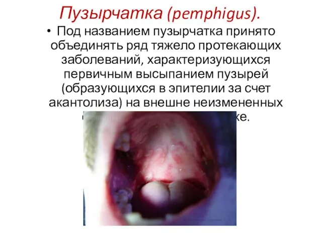 Пузырчатка (pemphigus). Под названием пузырчатка принято объединять ряд тяжело протекающих