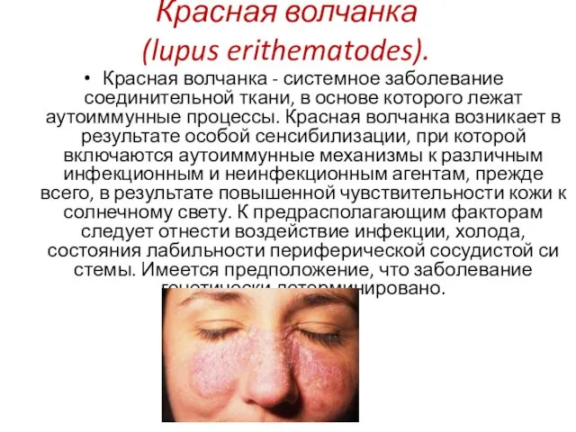 Красная волчанка (lupus erithematodes). Красная волчанка - системное заболевание соединительной