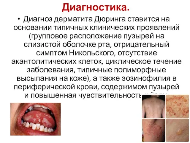 Диагностика. Диагноз дерматита Дюринга ставится на основании типичных клинических проявлений