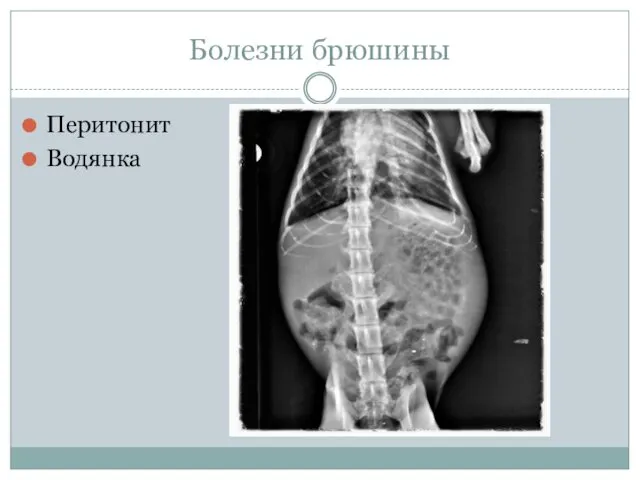 Болезни брюшины Перитонит Водянка