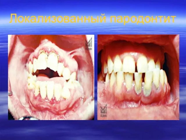 Локализованный пародонтит