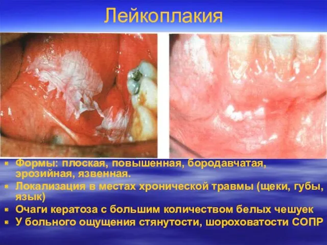 Лейкоплакия Формы: плоская, повышенная, бородавчатая, эрозийная, язвенная. Локализация в местах