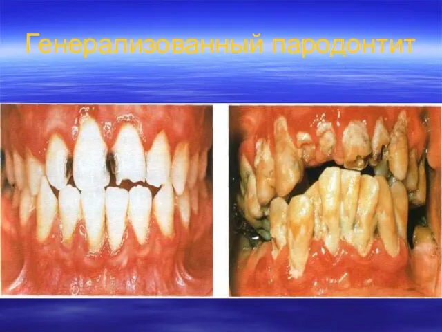 Генерализованный пародонтит