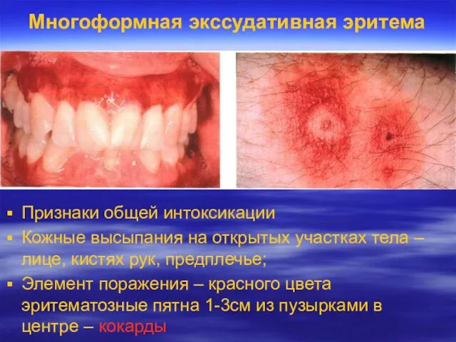 Многоформная экссудативная эритема Признаки общей интоксикации Кожные высыпания на открытых