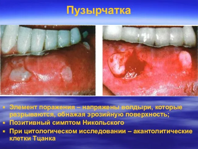 Пузырчатка Элемент поражения – напряжены волдыри, которые разрываются, обнажая эрозийную