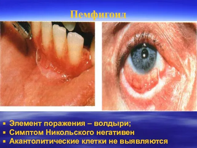 Пемфигоид Элемент поражения – волдыри; Симптом Никольского негативен Акантолитические клетки не выявляются