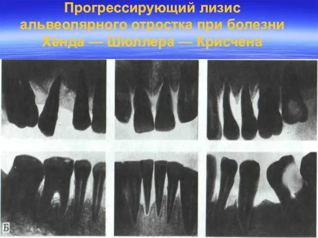 Прогрессирующий лизис альвеолярного отростка при болезни Хенда — Шюллера — Крисчена