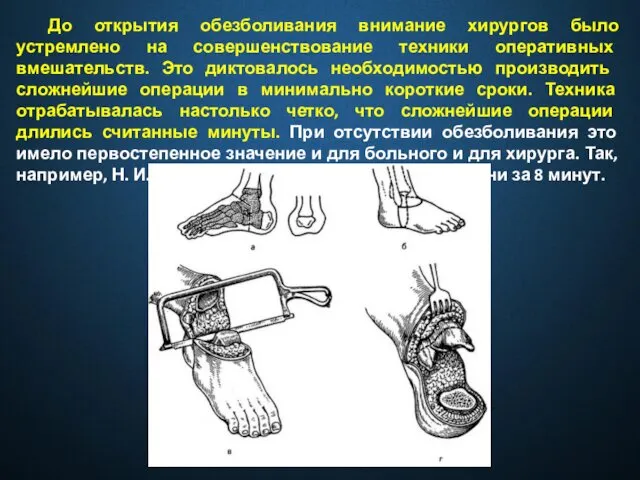 До открытия обезболивания внимание хирургов было устремлено на совер­шенствование техники