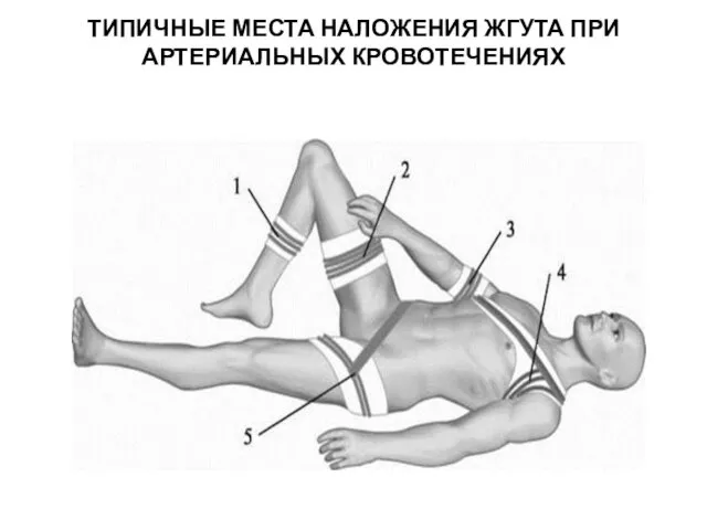 ТИПИЧНЫЕ МЕСТА НАЛОЖЕНИЯ ЖГУТА ПРИ АРТЕРИАЛЬНЫХ КРОВОТЕЧЕНИЯХ