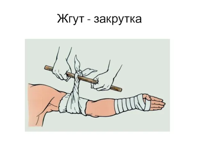 Жгут - закрутка