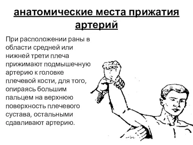 анатомические места прижатия артерий При расположении раны в области средней