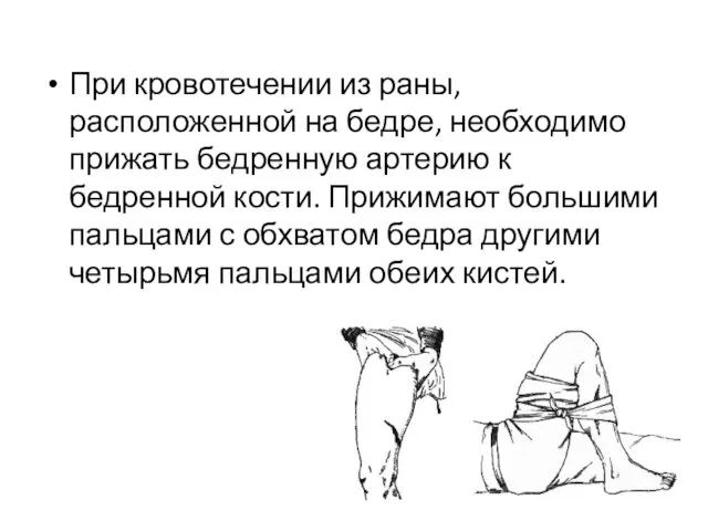 При кровотечении из раны, расположенной на бедре, необходимо прижать бедренную