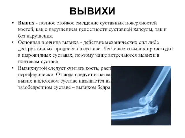 ВЫВИХИ Вывих - полное стойкое смещение суставных поверхностей костей, как