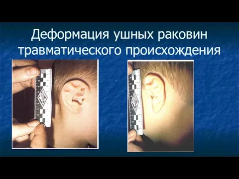 Деформация ушных раковин травматического происхождения