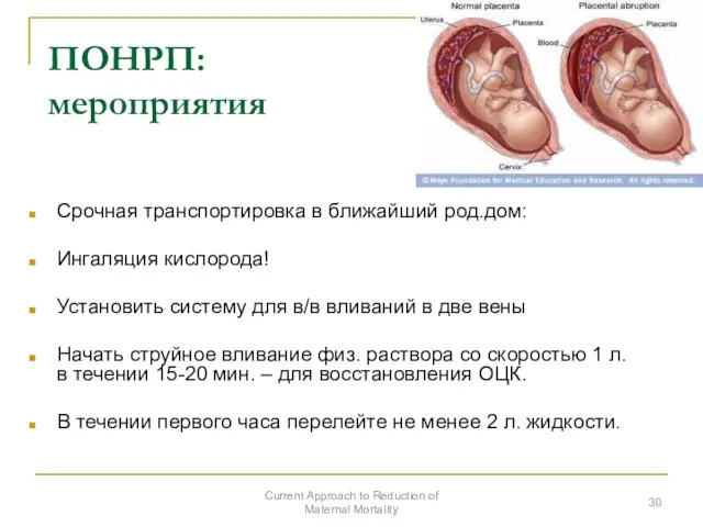 ПОНРП: мероприятия Срочная транспортировка в ближайший род.дом: Ингаляция кислорода! Установить