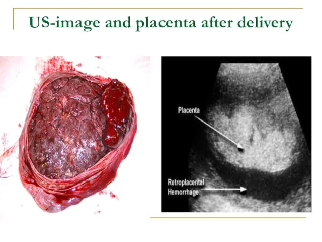 US-image and placenta after delivery